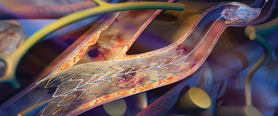 стентирование сонной артерии