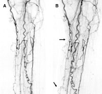 ангиография