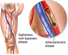 шунтирование