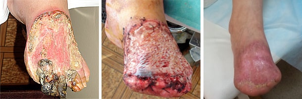 лечение гангрены