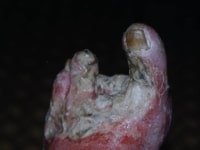 диабетическая гангрена