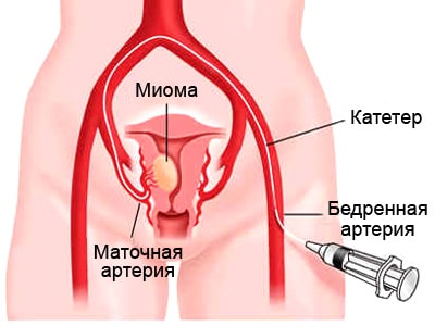 миома